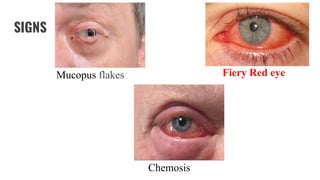 SIGNS
Mucopus flakes Fiery Red eye
Chemosis
 