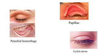 Eyelid edema
Petechial hemorrhage
Papillae
 