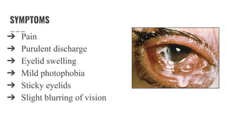 SYMPTOMS
➔ Pain
➔ Purulent discharge
➔ Eyelid swelling
➔ Mild photophobia
➔ Sticky eyelids
➔ Slight blurring of vision
 