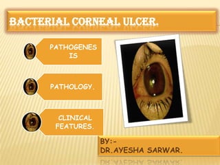 BACTERIAL CORNEAL ULCER.
PATHOGENES
IS
PATHOLOGY.
CLINICAL
FEATURES.
BY:-
DR.AYESHA SARWAR.
 
