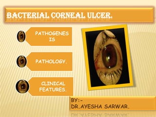 BACTERIAL CORNEAL ULCER.
PATHOGENES
IS
PATHOLOGY.
CLINICAL
FEATURES.
BY:-
DR.AYESHA SARWAR.
 