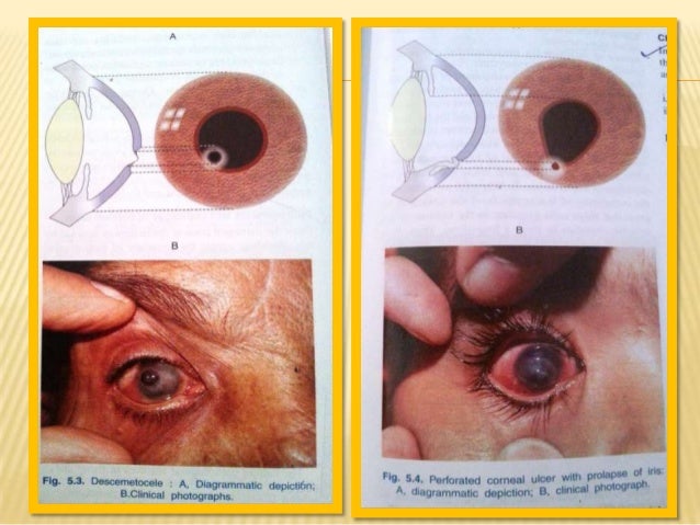 Bacterial corneal ulcer (Etilogy, pathogenesis, pathology ...