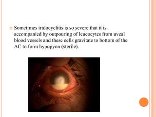

Sometimes iridocyclitis is so severe that it is
accompanied by outpouring of leucocytes from uveal
blood vessels and these cells gravitate to bottom of the
AC to form hypopyon (sterile).

 