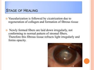 STAGE OF HEALING


Vascularization is followed by cicatrization due to
regeneration of collagen and formation of fibrous tissue



Newly formed fibers are laid down irregularly, not
conforming to normal pattern of stromal fibers.
Therefore this fibrous tissue refracts light irregularly and
forms opacity.

 