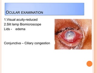 OCULAR EXAMINATION
1.Visual acuity-reduced
2.Slit lamp Biomicroscope
Lids - edema

Conjunctiva – Ciliary congestion

 