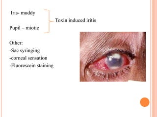 Iris- muddy
Toxin induced iritis

Pupil – miotic
Other:
-Sac syringing
-corneal sensation
-Fluorescein staining

 