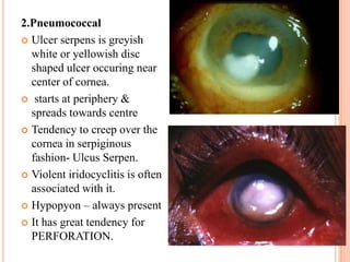 2.Pneumococcal
 Ulcer serpens is greyish
white or yellowish disc
shaped ulcer occuring near
center of cornea.
 starts at periphery &
spreads towards centre
 Tendency to creep over the
cornea in serpiginous
fashion- Ulcus Serpen.
 Violent iridocyclitis is often
associated with it.
 Hypopyon – always present
 It has great tendency for
PERFORATION.

 