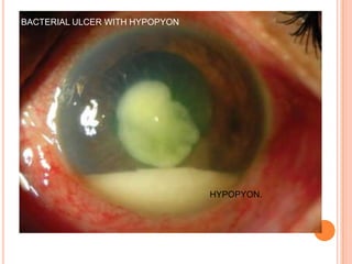 BACTERIAL ULCER WITH HYPOPYON

HYPOPYON.

 
