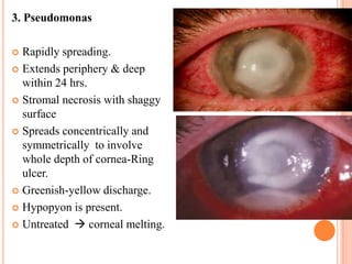 3. Pseudomonas
Rapidly spreading.
 Extends periphery & deep
within 24 hrs.
 Stromal necrosis with shaggy
surface
 Spreads concentrically and
symmetrically to involve
whole depth of cornea-Ring
ulcer.
 Greenish-yellow discharge.
 Hypopyon is present.
 Untreated  corneal melting.


 