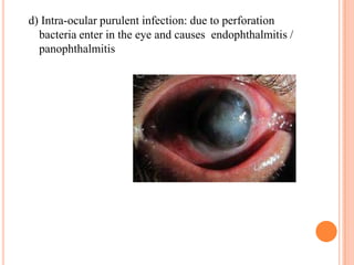 d) Intra-ocular purulent infection: due to perforation
bacteria enter in the eye and causes endophthalmitis /
panophthalmitis

 