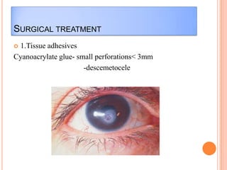 SURGICAL TREATMENT
1.Tissue adhesives
Cyanoacrylate glue- small perforations< 3mm
-descemetocele


 