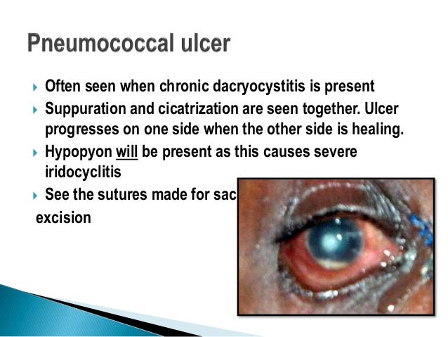 Bacterial corneal ulcer