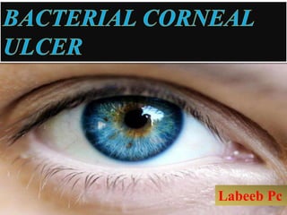 BACTERIAL CORNEAL
ULCER
Labeeb Pc
 