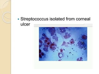  Streptococcus isolated from corneal
ulcer
 