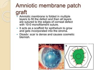 Amniotic membrane patch
graft
 Amniotic membrane is folded in multiple
layers to fill the defect and then all layers
are sutured to the edges of corneal defect
with 10-0 monofilament suture.
 It acts as a scaffold for epithelium to grow
and gets incorporated into the stroma.
 Disadv: scar is dense and causes cosmetic
blemish.
 