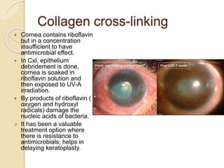 Collagen cross-linking
 Cornea contains riboflavin
but in a concentration
insufficient to have
antimicrobial effect.
 In Cxl, epithelium
debridement is done,
cornea is soaked in
riboflavin solution and
then exposed to UV-A
irradiation.
 By products of riboflavin (
oxygen and hydroxyl
radicals) damage the
nucleic acids of bacteria.
 It has been a valuable
treatment option where
there is resistance to
antimicrobials; helps in
delaying keratoplasty.
 