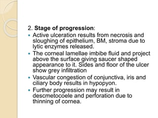 2. Stage of progression:
 Active ulceration results from necrosis and
sloughing of epithelium, BM, stroma due to
lytic enzymes released.
 The corneal lamellae imbibe fluid and project
above the surface giving saucer shaped
appearance to it. Sides and floor of the ulcer
show grey infiltration
 Vascular congestion of conjunctiva, iris and
ciliary body results in hypopyon.
 Further progression may result in
descmetocoele and perforation due to
thinning of cornea.
 