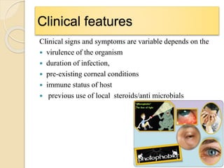 Clinical features
Clinical signs and symptoms are variable depends on the
 virulence of the organism
 duration of infection,
 pre-existing corneal conditions
 immune status of host
 previous use of local steroids/anti microbials
 