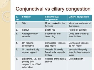 Conjunctival vs ciliary congestion
S.
no.
Feature Conjunctival
congestion
Ciliary congestion
1. Site More marked in the
fornices
More marked around
the limbus
2. Colour Bright red Purple or dull red
3. Arrangement of
vessels
Superficial and
branching
Deep and radiating
from limbus
4. On moving
conjunctiva
Congested vessels
also move
Congested vessels
do not move
5. On mechanically
squeezing out
Vessels fill slowly
from fornix towards
limbus
Vessels fill rapidly
from limbus towards
fornix
6. Blanching, i.e., on
putting one
drop of 1 in 10000
adrenaline
Vessels immediately
blanch
Do not blanch
 