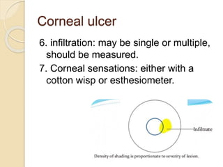 Corneal ulcer
6. infiltration: may be single or multiple,
should be measured.
7. Corneal sensations: either with a
cotton wisp or esthesiometer.
 
