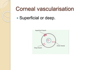 Corneal vascularisation
 Superficial or deep.
 