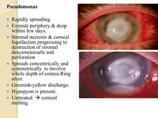 Pseudomonas
 Rapidly spreading.
 Extends periphery & deep
within few days.
 Stromal necrosis & corneal
liquifaction progressing to
destruction of stromal
descemetocoele and
perforation
 Spreads concentrically and
symmetrically to involve
whole depth of cornea-Ring
ulcer.
 Greenish-yellow discharge.
 Hypopyon is present.
 Untreated  corneal
melting.
 