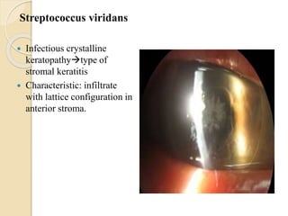 Streptococcus viridans
 Infectious crystalline
keratopathytype of
stromal keratitis
 Characteristic: infiltrate
with lattice configuration in
anterior stroma.
 