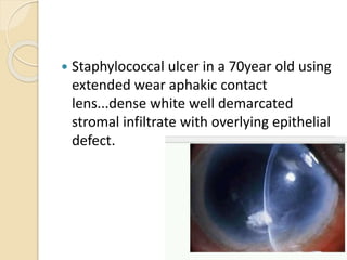  Staphylococcal ulcer in a 70year old using
extended wear aphakic contact
lens...dense white well demarcated
stromal infiltrate with overlying epithelial
defect.
 