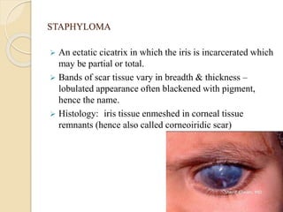 STAPHYLOMA
 An ectatic cicatrix in which the iris is incarcerated which
may be partial or total.
 Bands of scar tissue vary in breadth & thickness –
lobulated appearance often blackened with pigment,
hence the name.
 Histology: iris tissue enmeshed in corneal tissue
remnants (hence also called corneoiridic scar)
 