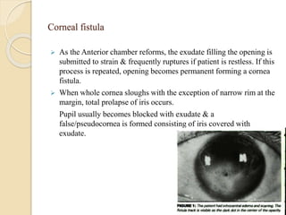 Corneal fistula
 As the Anterior chamber reforms, the exudate filling the opening is
submitted to strain & frequently ruptures if patient is restless. If this
process is repeated, opening becomes permanent forming a cornea
fistula.
 When whole cornea sloughs with the exception of narrow rim at the
margin, total prolapse of iris occurs.
Pupil usually becomes blocked with exudate & a
false/pseudocornea is formed consisting of iris covered with
exudate.
 