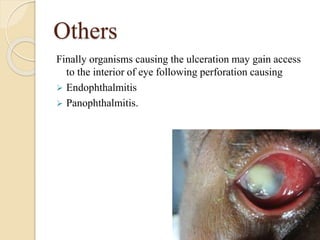 Others
Finally organisms causing the ulceration may gain access
to the interior of eye following perforation causing
 Endophthalmitis
 Panophthalmitis.
 