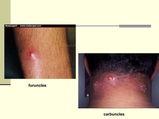 Bacterial Infection (แพทย์) | PPT