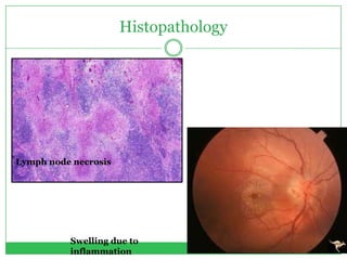 Histopathology
Lymph node necrosis
Swelling due to
inflammation
 