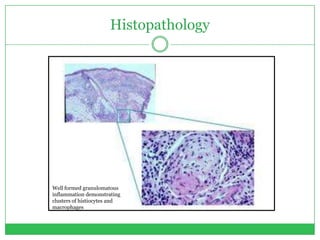 Histopathology
Well formed granulomatous
inflammation demonstrating
clusters of histiocytes and
macrophages
 