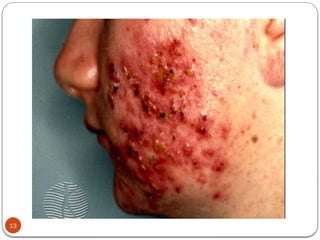 Skin Funicle Comprehensive Overview of Folliculitis, Furuncle, Carbuncle, and ...