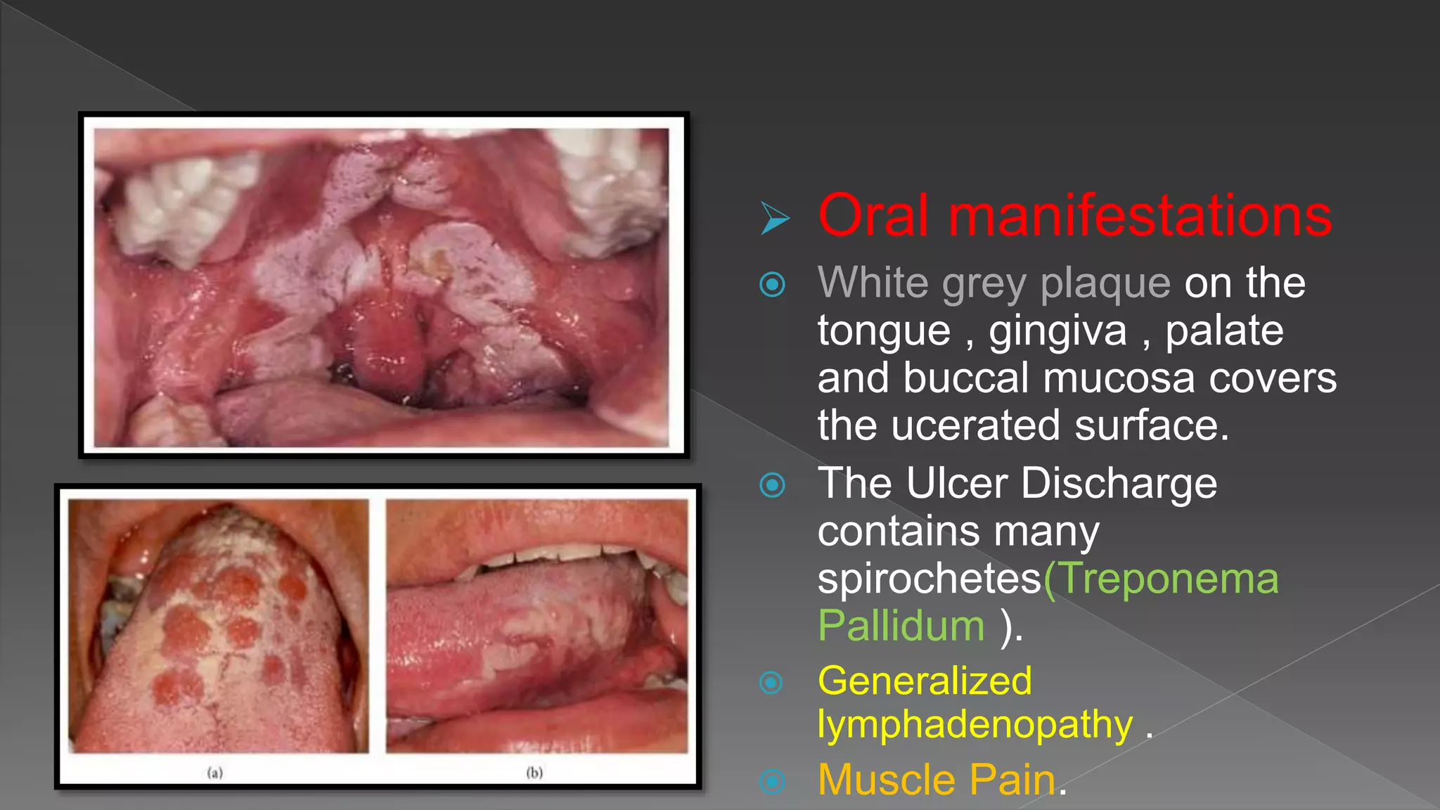 Palatal Infection Bacterial infection of the oral cavity (khaled sadeq) | PPTX