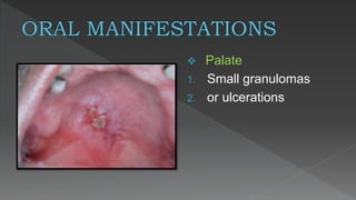 Bacterial infection of the oral cavity (khaled sadeq) | PPTX