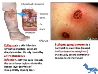 Bacterial infection of the skin | PPTX