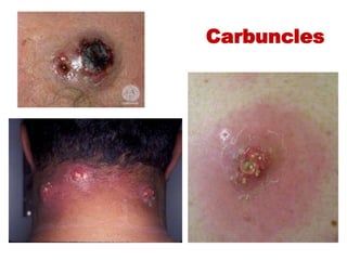 Back Carbuncle Bacterial infection of the skin | PPTX