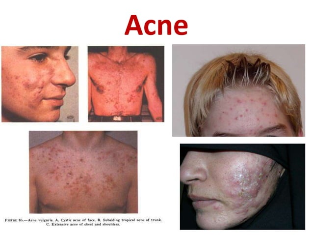 Bacterial infection of the skin | PPTX