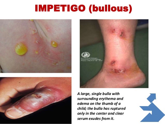 bacterial skin infection picture