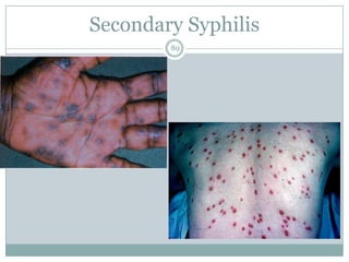 Secondary Syphilis
89
 