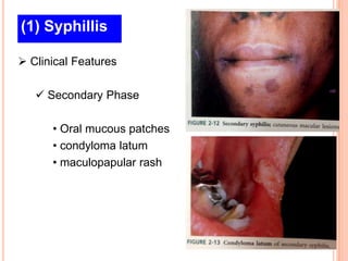 (1) Syphillis

 Clinical Features

    Secondary Phase

      • Oral mucous patches
      • condyloma latum
      • maculopapular rash
 