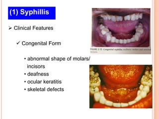 (1) Syphillis

 Clinical Features

    Congenital Form

      • abnormal shape of molars/
        incisors
      • deafness
      • ocular keratitis
      • skeletal defects
 