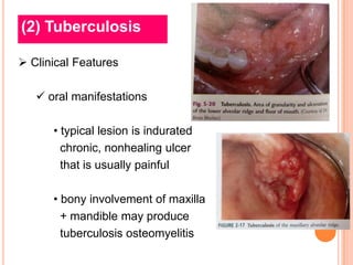 (2) Tuberculosis

 Clinical Features

    oral manifestations

      • typical lesion is indurated
        chronic, nonhealing ulcer
        that is usually painful

      • bony involvement of maxilla
        + mandible may produce
        tuberculosis osteomyelitis
 