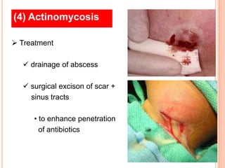(4) Actinomycosis

 Treatment

   drainage of abscess

   surgical excison of scar +
    sinus tracts

     • to enhance penetration
       of antibiotics
 