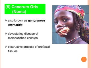 (5) Cancrum Oris
    (Noma)

 also known as gangrenous
  stomatitis

 devastating disease of
  malnourished children

 destructive process of orofacial
  tissues
 