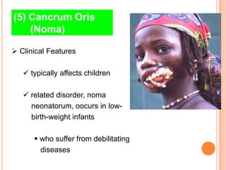(5) Cancrum Oris
    (Noma)

 Clinical Features

    typically affects children

    related disorder, noma
     neonatorum, oocurs in low-
     birth-weight infants

       who suffer from debilitating
        diseases
 