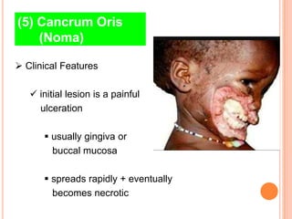 (5) Cancrum Oris
    (Noma)

 Clinical Features

    initial lesion is a painful
     ulceration

       usually gingiva or
        buccal mucosa

       spreads rapidly + eventually
        becomes necrotic
 