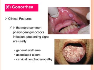 (6) Gonorrhea

 Clinical Features

    in the more common
     pharyngeal gonococcal
     infection, presenting signs
     are usally

      • general erythema
      • associated ulcers
      • cervical lymphadenopathy
 
